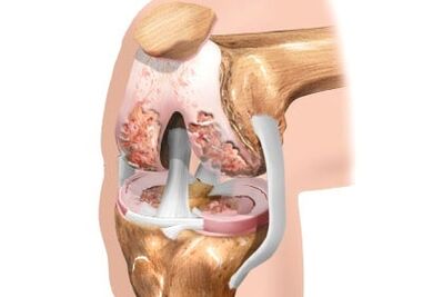 Damage to the knee joint trose