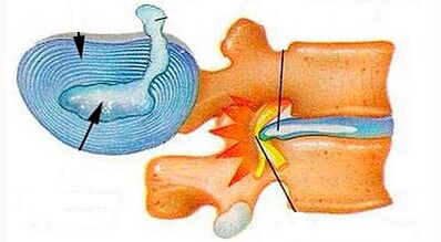 Features of developing cervical osteocondrosis